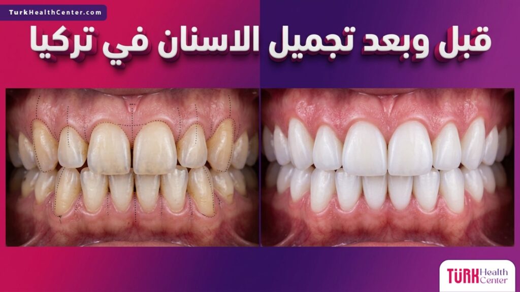 صورة واقعية مقارنة قبل وبعد تظهر التحول الجذري والنتائج المذهلة لعملية تجميل الاسنان في تركيا