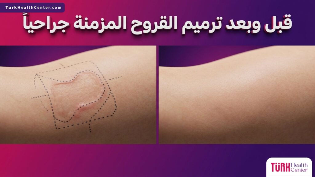 صورة قبل وبعد توضح نتائج ترميم القروح المزمنة جراحياً مع علامات التخطيط الطبي الجراحي.