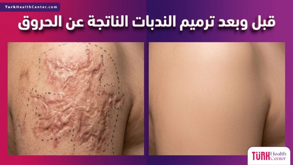 صورة مقسمة واقعية توضح الفرق قبل وبعد ترميم الندبات الناتجة عن الحروق مع إظهار تحسن ملمس الجلد.