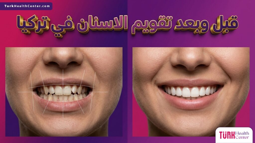 مقارنة قبل وبعد تظهر نتائج تقويم الاسنان في تركيا وتعديل اصطفاف الأسنان بدقة.