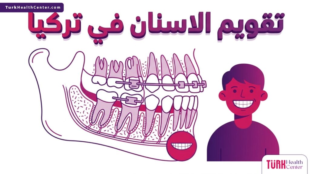 إنفوجرافيك تشريحي يوضح آلية عمل تقويم الاسنان في تركيا وحركة الجذور داخل عظام الفك.