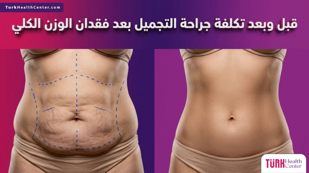مقارنة قبل وبعد توضح النتائج المتعلقة بموضوع تكلفة جراحة التجميل بعد فقدان الوزن الكلي وتأثيرها على شد قوام الجسم.