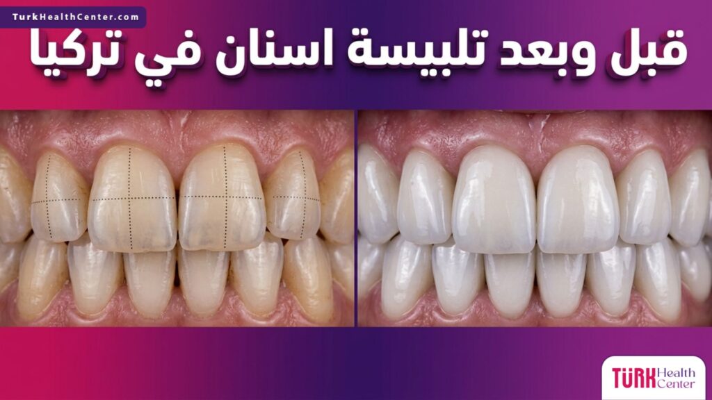 مقارنة قبل وبعد توضح التحول الجذري والنتائج المثالية لإجراء تلبيسة اسنان في تركيا باستخدام الزركون.