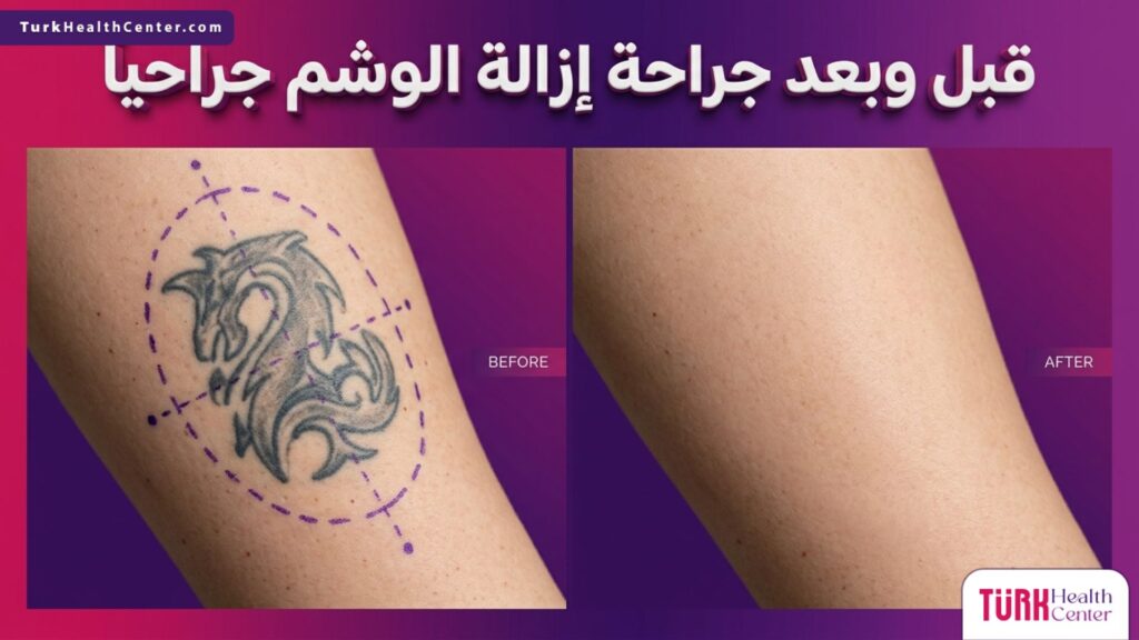مقارنة قبل وبعد تظهر الجلد الموشوم مع علامات الجراحة الطبية، والنتيجة النهائية لبشرة صافية بعد جراحة إزالة الوشم جراحياً.