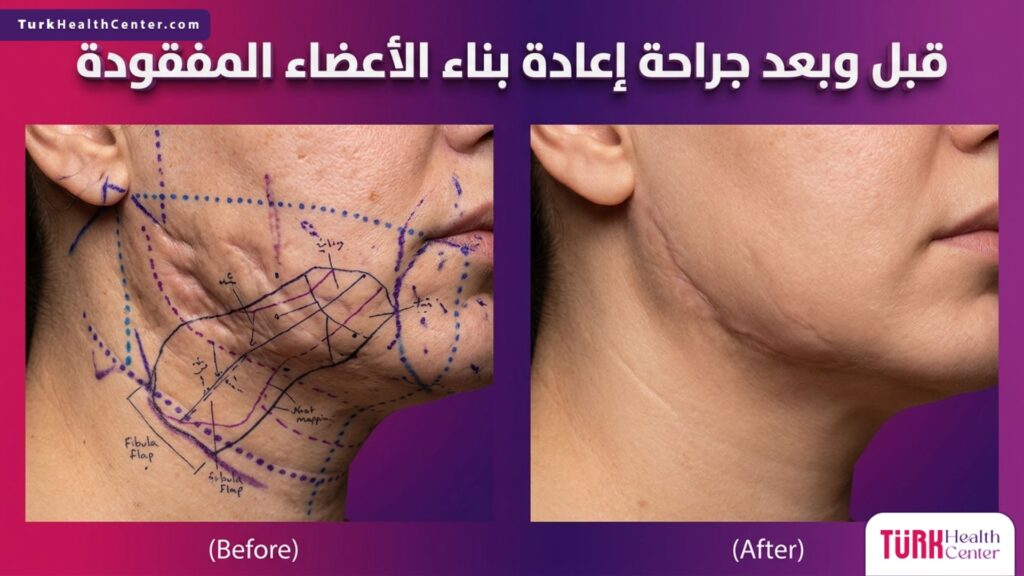 صورة مقسمة تظهر حالة المريض قبل وبعد جراحة إعادة بناء الأعضاء المفقودة مع خطوط التخطيط الطبي الدقيقة.