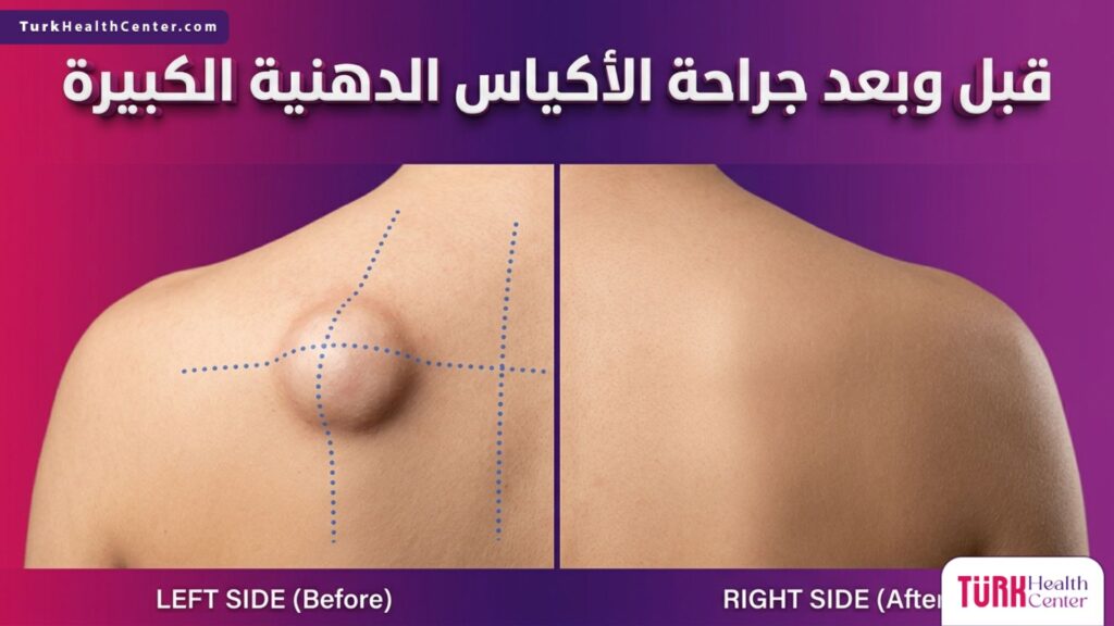 مقارنة قبل وبعد جراحة الأكياس الدهنية الكبيرة تظهر التخلص التام من الكيس الدهني مع نتائج تجميلية مثالية.