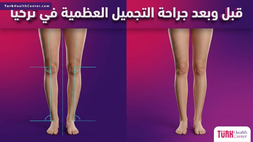 مقارنة قبل وبعد جراحة التجميل العظمية في تركيا توضح دقة التخطيط الطبي والنتائج المثالية لتصحيح العظام.