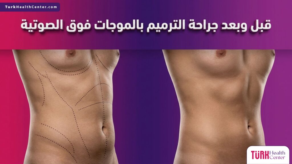 مقارنة قبل وبعد تظهر النتائج الدقيقة والمثالية لإجراء جراحة الترميم بالموجات فوق الصوتية.