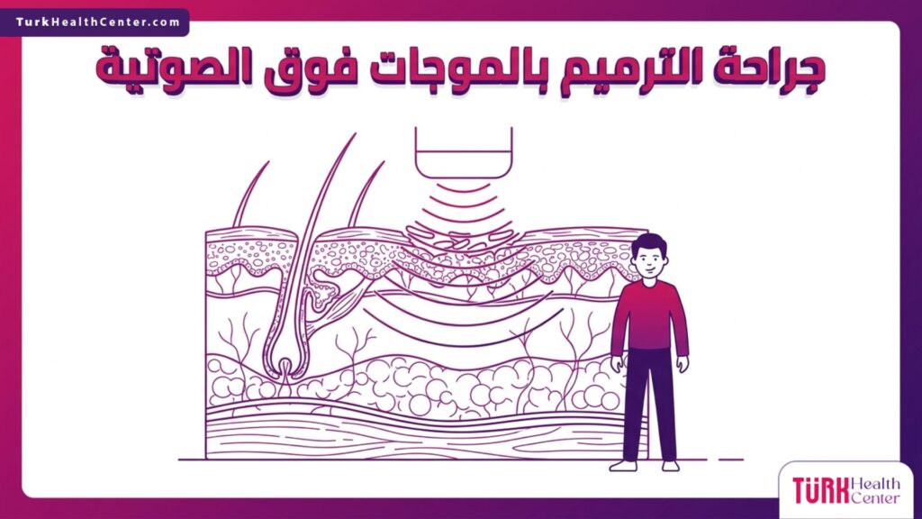 إنفوجرافيك طبي دقيق يوضح الطبقات التشريحية وآلية عمل جراحة الترميم بالموجات فوق الصوتية.