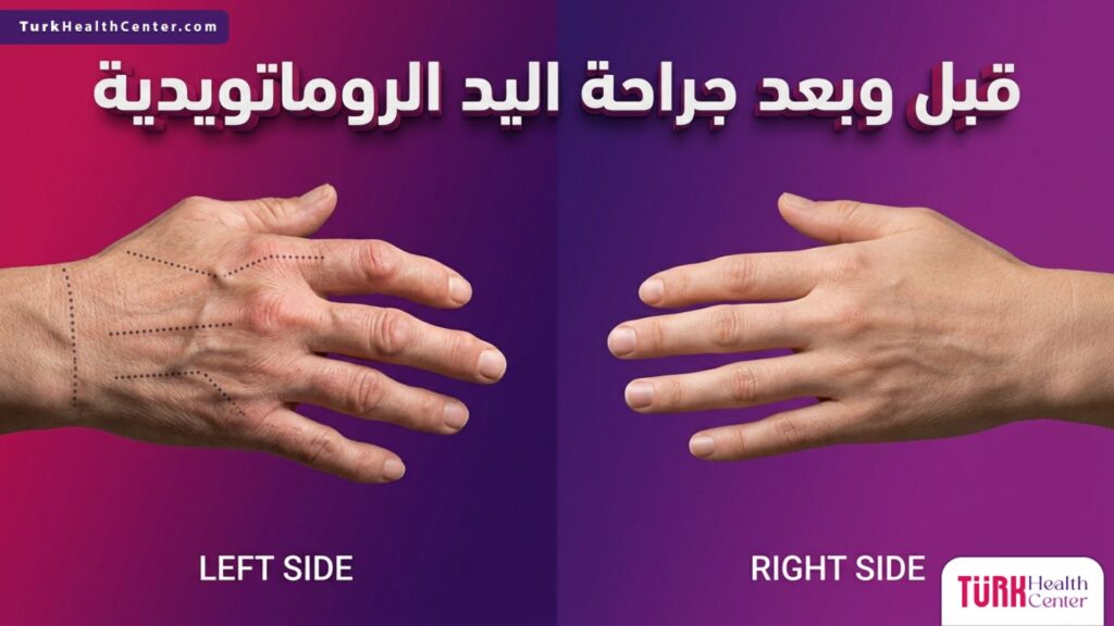 صورة مقسمة توضح شكل المفاصل قبل وبعد جراحة اليد الروماتويدية مع إبراز تحسن استقامة ووظيفة اليد.