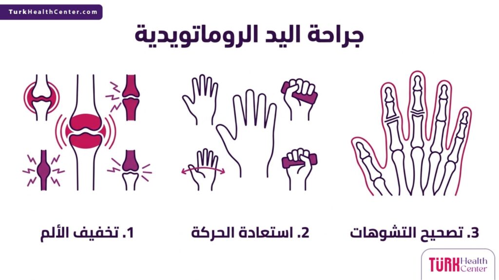إنفوجرافيك علمي يشرح مراحل وفوائد جراحة اليد الروماتويدية من تخفيف الألم إلى استعادة الحركة وتصحيح التشوهات.