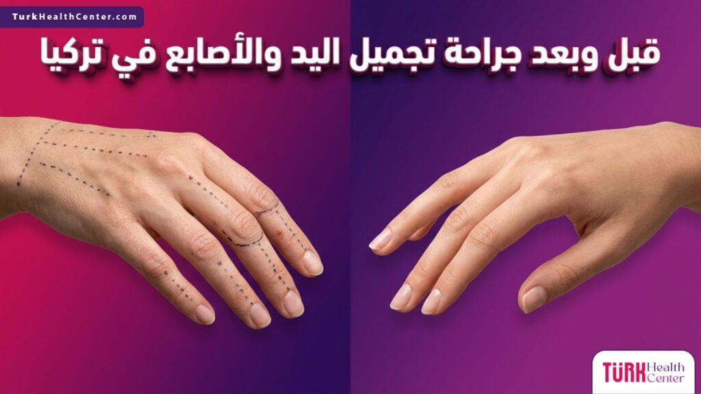 مقارنة قبل وبعد جراحة تجميل اليد والأصابع في تركيا تظهر التطور المذهل والعلامات الجراحية.
