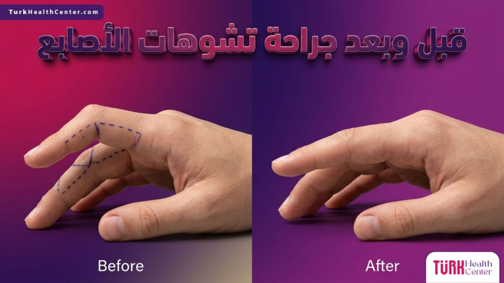 مقارنة قبل وبعد جراحة تشوهات الأصابع تظهر التعديلات الطبية الدقيقة لاستعادة الشكل الطبيعي لليد.