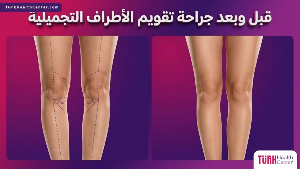 صورة مقارنة دقيقة قبل وبعد جراحة تقويم الأطراف التجميلية تظهر خطوط التخطيط الطبي والنتيجة المتناسقة المثالية.
