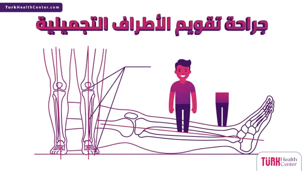 إنفوجرافيك طبي متجهي يوضح البنية التشريحية للعظام وكيفية عمل جراحة تقويم الأطراف التجميلية علمياً.