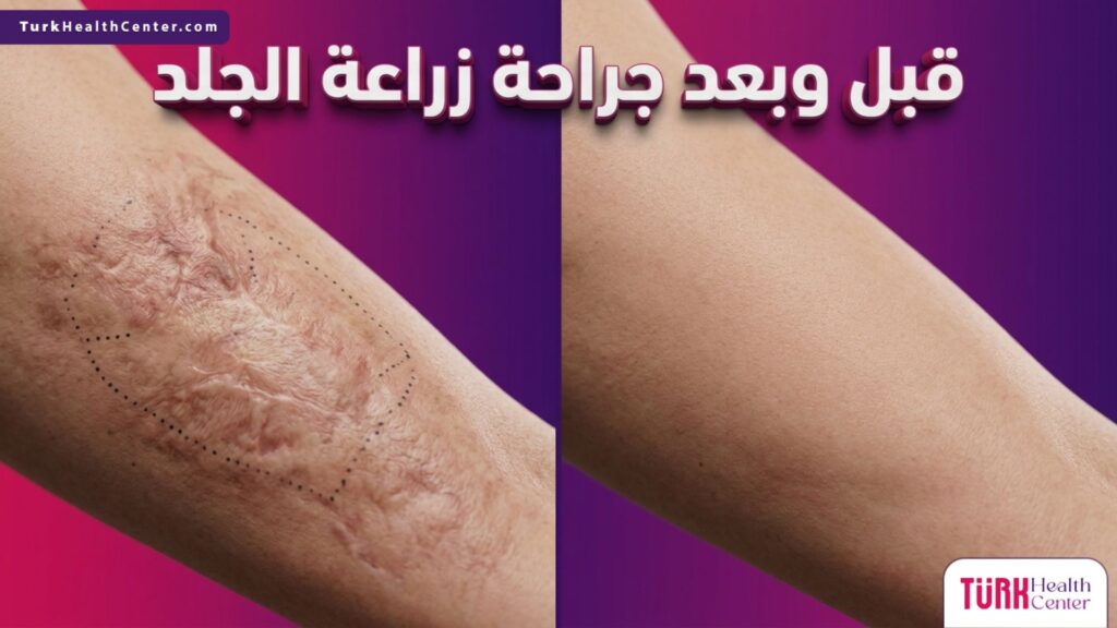 صورة مقسمة توضح حالة الأنسجة قبل وبعد إجراء جراحة زراعة الجلد لبيان مدى التحسن والشفاء.