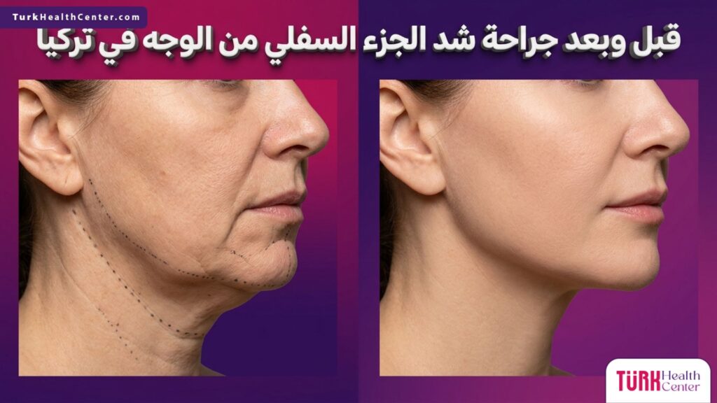 صورة مقسومة توضح نتائج قبل وبعد جراحة شد الجزء السفلي من الوجه في تركيا مع تحديد خط الفك.