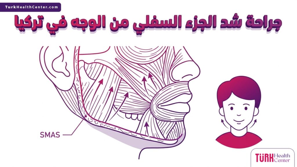 إنفوجرافيك طبي تشريحي يوضح تقنية الطبقات العضلية في جراحة شد الجزء السفلي من الوجه في تركيا.