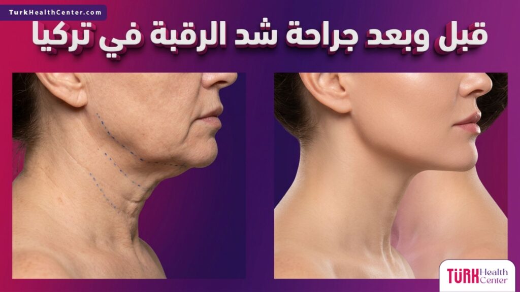 صورة قبل وبعد تظهر نتائج جراحة شد الرقبة في تركيا بوضوح تام