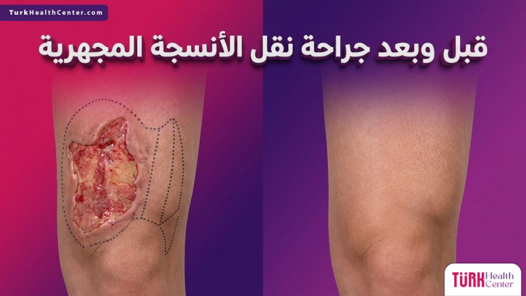 صورة مقسمة واقعية توضح التغيرات قبل وبعد جراحة نقل الأنسجة المجهرية مع تحديد العلامات الجراحية والنتيجة النهائية المتعافية.