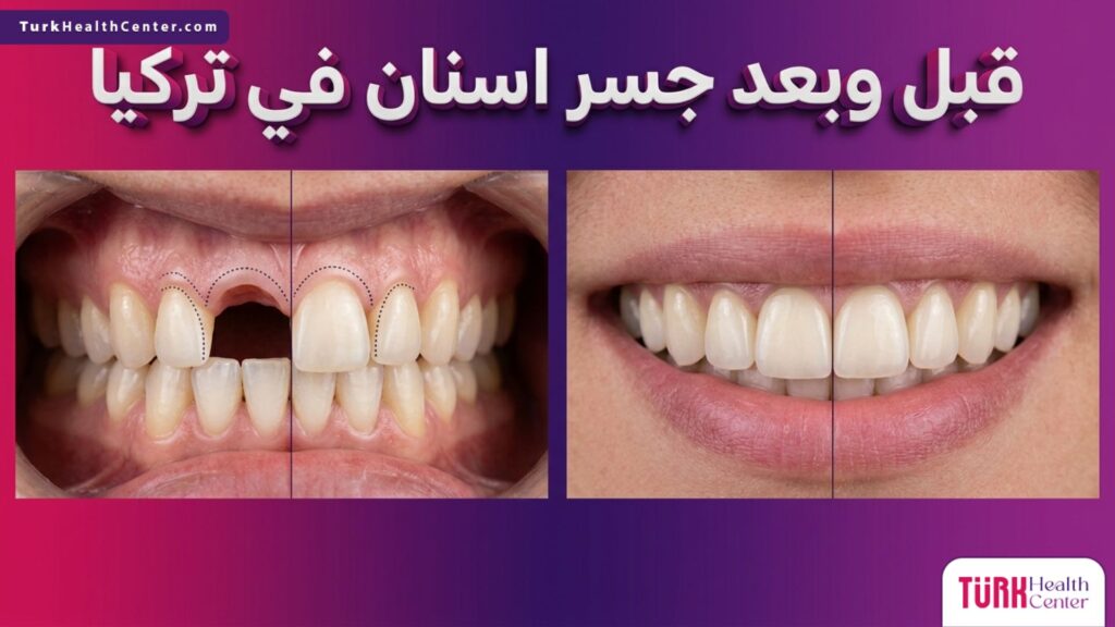 مقارنة قبل وبعد توضح نتائج تركيب جسر اسنان في تركيا