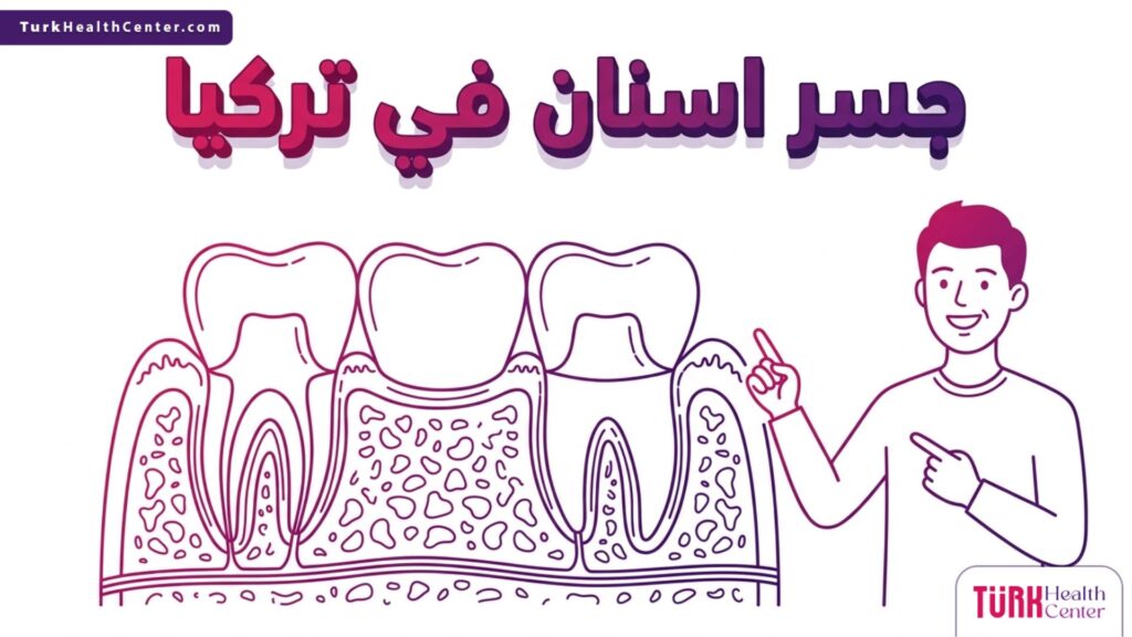 رسم توضيحي تشريحي يشرح الهيكل الهندسي لدعم جسر اسنان في تركيا