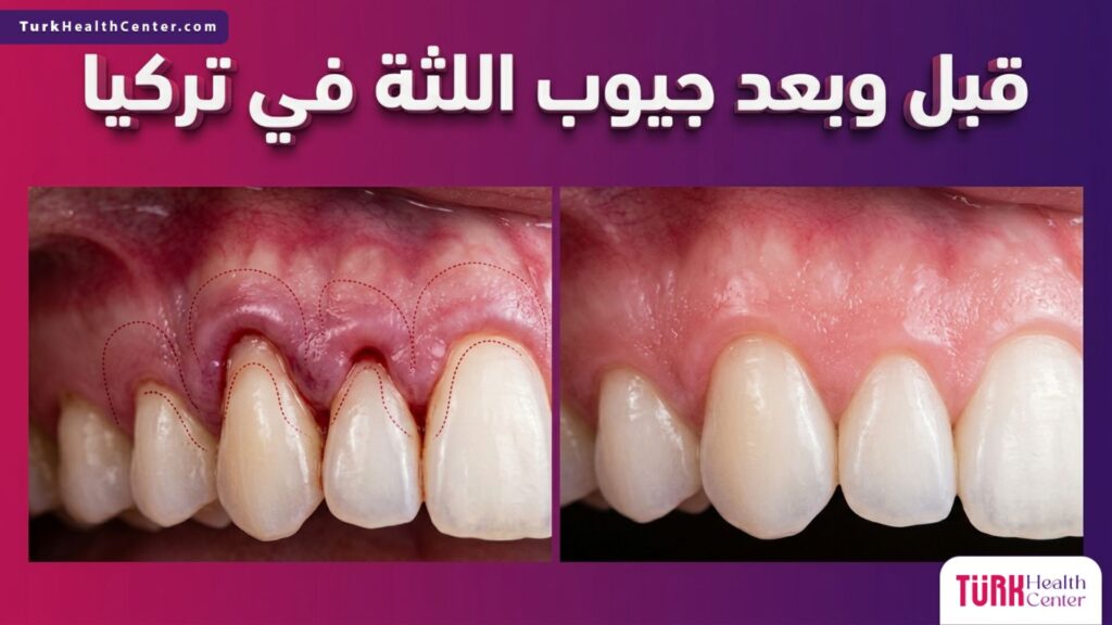 صورة قبل وبعد تظهر فعالية علاج جيوب اللثة في تركيا مع تحسن واضح