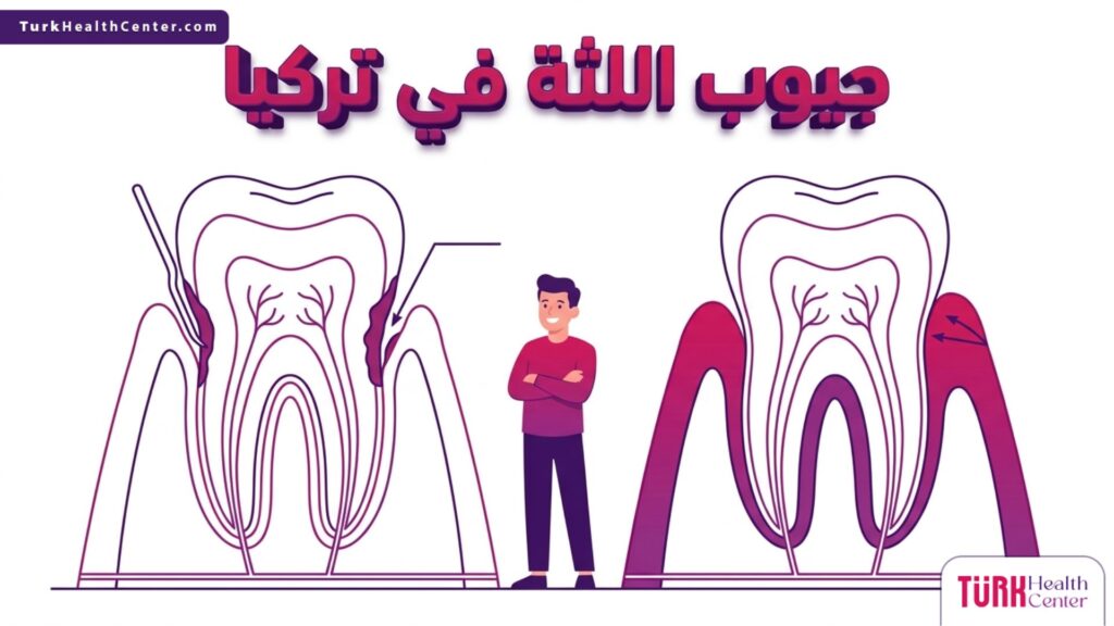إنفوجرافيك تشريحي ثلاثي الأبعاد يوضح تفاصيل جيوب اللثة في تركيا وطرق علاجها طبياً