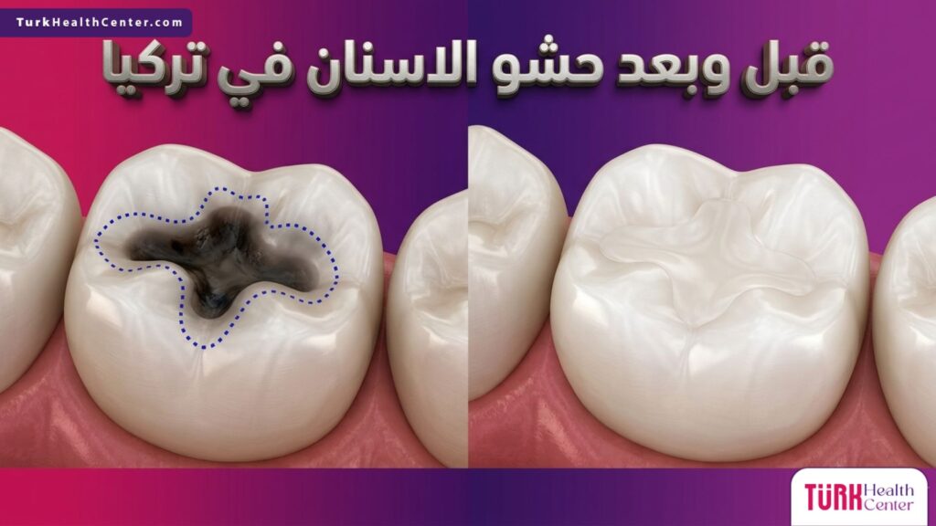 صورة مقسمة تظهر نموذج السن قبل وبعد إجراء حشو الاسنان في تركيا.