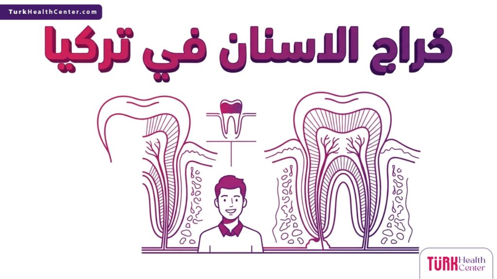 رسم إنفوجرافيك طبي دقيق يوضح التشريح الداخلي وخطوات علاج خراج الاسنان في تركيا.