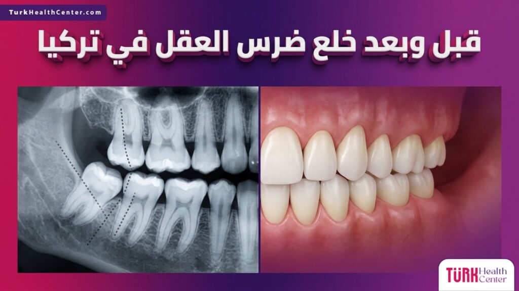 صورة مقسمة تظهر حالة الفم قبل وبعد خلع ضرس العقل في تركيا لضمان صحة الأسنان المجاورة.