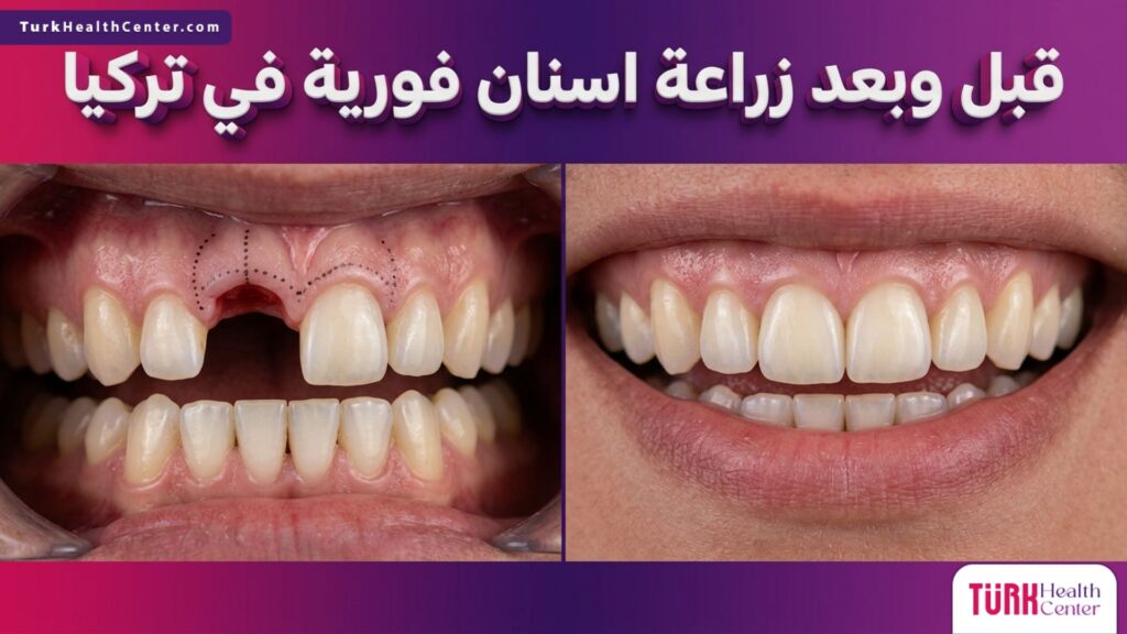 مقارنة قبل وبعد توضح النتائج المذهلة لعملية زراعة اسنان فورية في تركيا مع خطوط توجيهية طبية.
