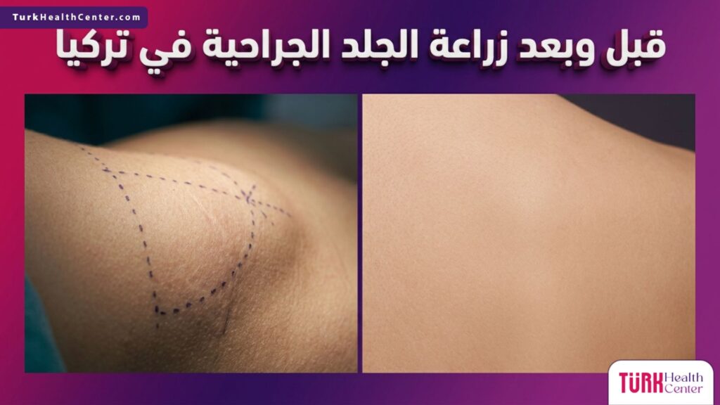 مقارنة قبل وبعد زراعة الجلد الجراحية في تركيا تظهر التحضيرات الطبية والنتيجة النهائية لجلد صحي.