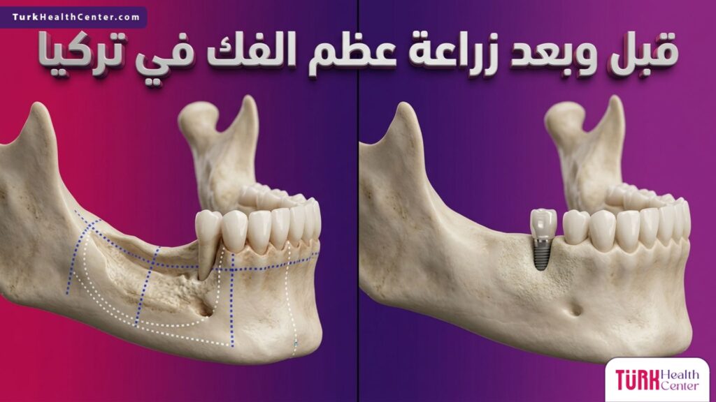 صورة مقارنة تظهر حالة الفك قبل وبعد زراعة عظم الفك في تركيا مع إظهار تجدد الكثافة العظمية.