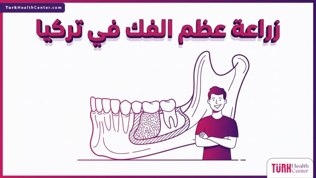 رسم تشريحي هندسي دقيق يوضح البنية الداخلية لعملية زراعة عظم الفك في تركيا مع مريض سعيد بالنتيجة.