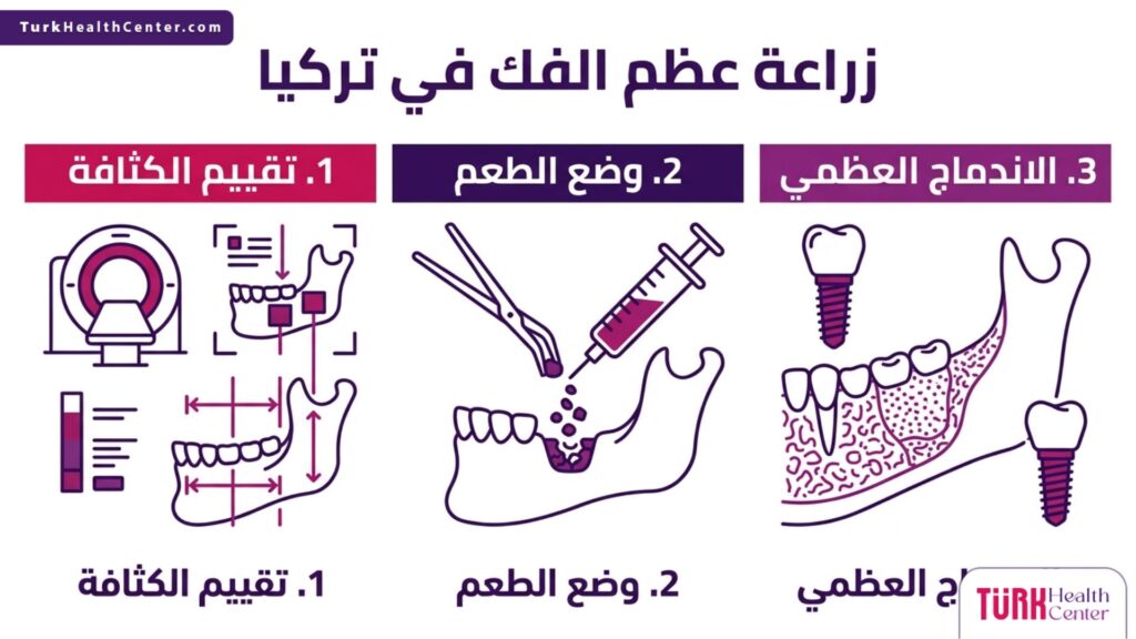 إنفوجرافيك طبي متخصص يشرح المراحل الأساسية الثلاث لعملية زراعة عظم الفك في تركيا.
