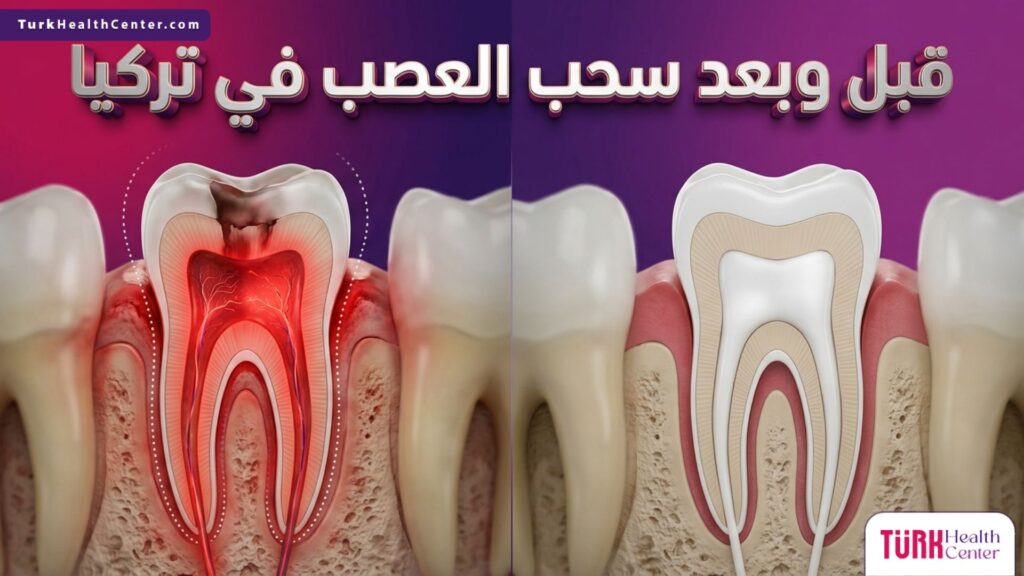 مقارنة تفصيلية قبل وبعد سحب العصب في تركيا تظهر إزالة الالتهاب وحشو القنوات العصبية بدقة لضمان سلامة السن.