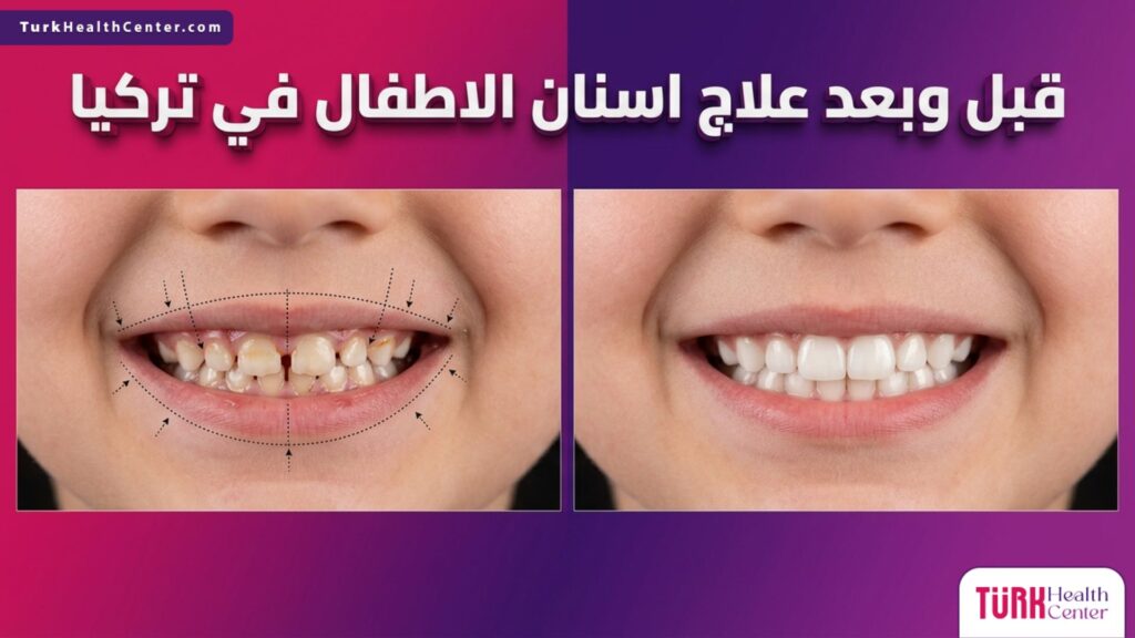 صورة مقسومة تظهر نتائج قبل وبعد علاج اسنان الاطفال في تركيا وإصلاح التسوس للحصول على أسنان بيضاء وسليمة.