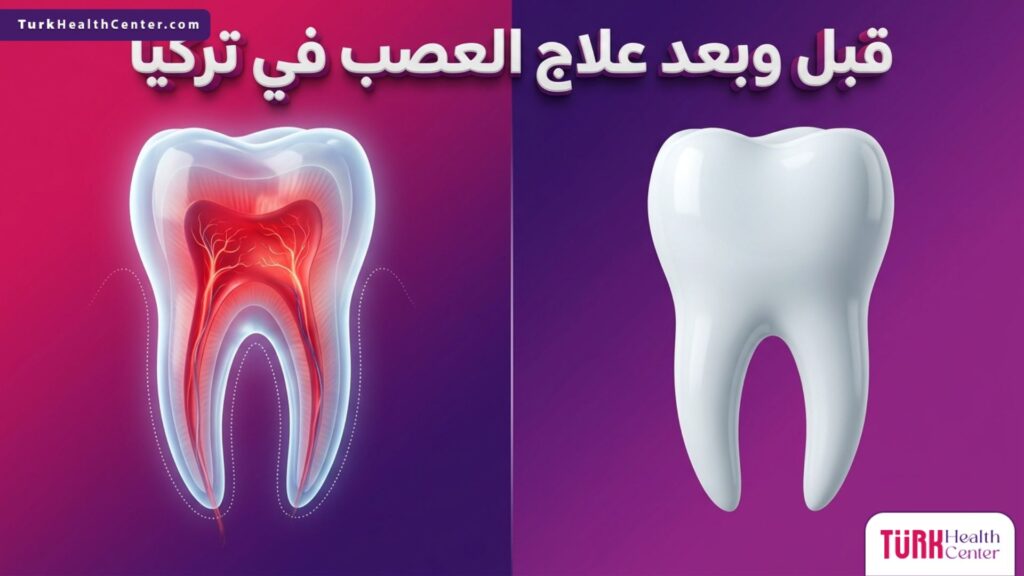 صورة تظهر الفرق قبل وبعد علاج العصب في تركيا مع توضيح شكل السن الملتهب والسن المعالج.