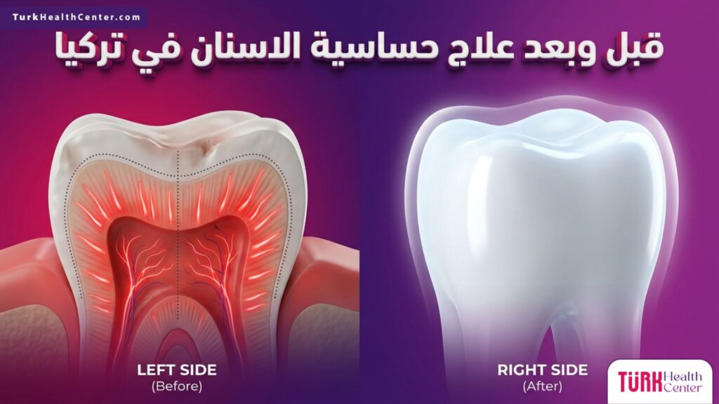 مقارنة قبل وبعد لسن متضرر وسن معافى تماماً توضح نتائج علاج حساسية الاسنان في تركيا باستخدام تقنيات حديثة.
