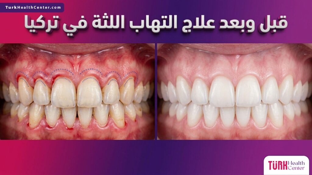 صورة قبل وبعد تظهر النتائج المذهلة لـ علاج نزيف اللثة في تركيا وتوضح تحول اللثة إلى الحالة الصحية.