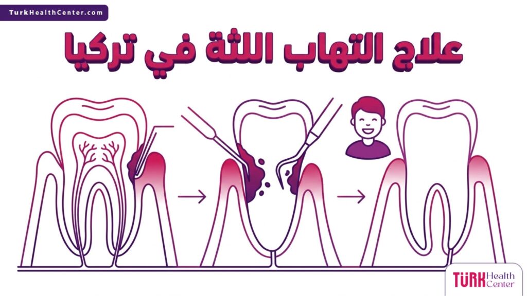 إنفوجرافيك تشريحي دقيق يوضح التركيب الداخلي للأسنان واللثة وطريقة علاج نزيف اللثة في تركيا.