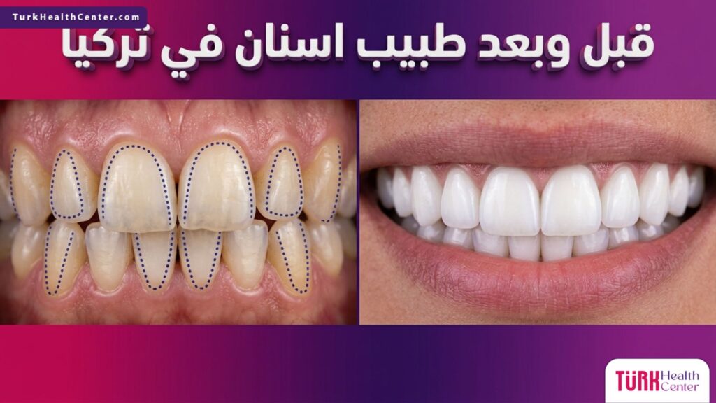 صورة مقسومة واقعية تظهر تحول الابتسامة قبل وبعد العلاج مع طبيب اسنان في تركيا، توضح الانتقال من أسنان غير متناسقة إلى ابتسامة مثالية.