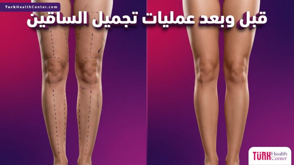 مقارنة قبل وبعد عمليات تجميل الساقين تظهر التحديدات الجراحية والنتيجة النهائية المتناسقة.