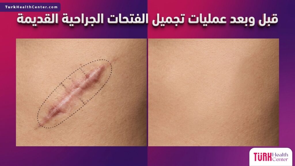 صورة مقسمة واقعية توضح التغير المذهل قبل وبعد عمليات تجميل الفتحات الجراحية القديمة لاستعادة نعومة الجلد