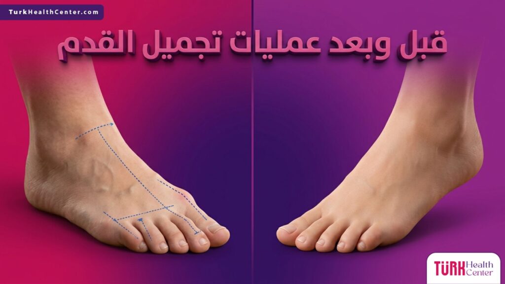 مقارنة بصرية قبل وبعد عمليات تجميل القدم تبرز التحول المذهل في شكل وملامح القدم وتصحيح العظام.