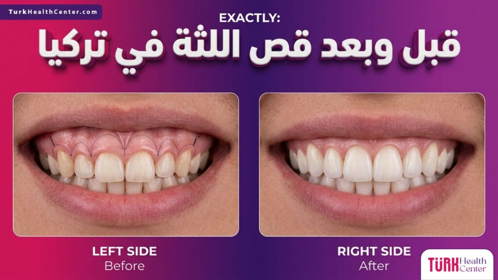 صورة مقسمة تظهر حالة الابتسامة والأسنان قبل وبعد قص اللثة في تركيا مع إبراز خطوط الجراحة الدقيقة.
