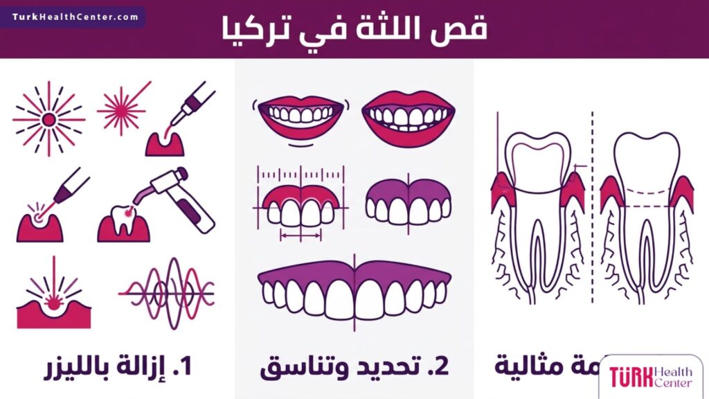 تصميم إنفوجرافيك يوضح خطوات ومميزات إجراء قص اللثة في تركيا باستخدام تقنيات الليزر.