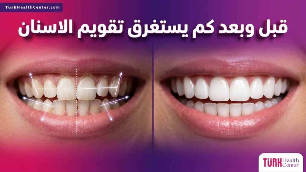مقارنة قبل وبعد تظهر تأثير العلاج وتوضح كم يستغرق تقويم الاسنان للحصول على أسنان مستقيمة.