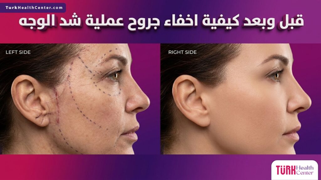 صورة مقسمة تظهر قبل وبعد كيفية اخفاء جروح عملية شد الوجه مع شفاء تام للبشرة